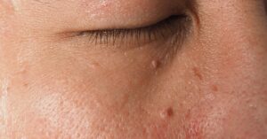 papilomi-bradavice-poliklinika-diva-dr-bogdanovic