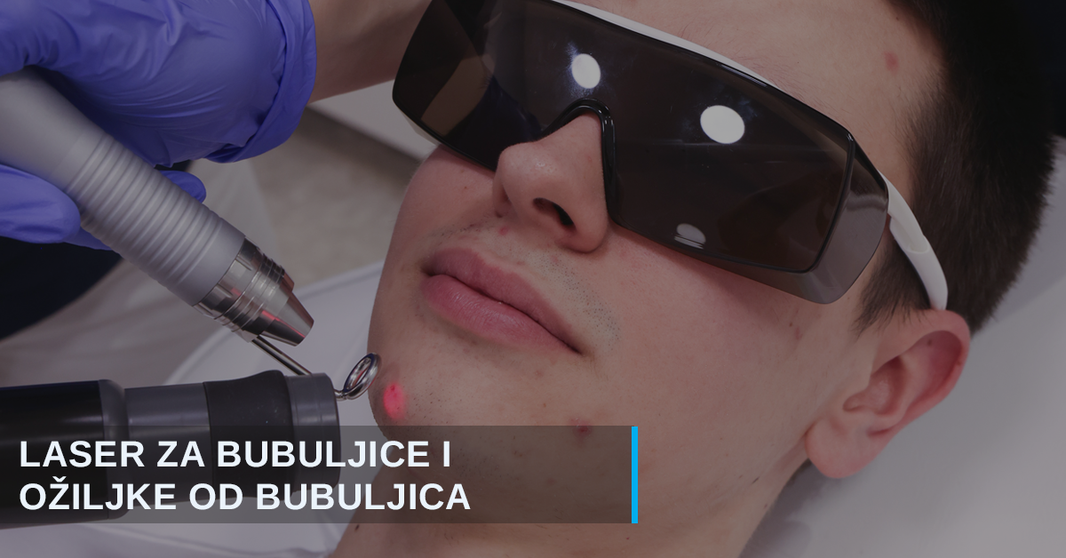Bubuljice i ožiljci od bubuljica: uzroci, lečenje i lasersko uklanjanje