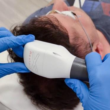 Hair Restart laserski tretman za kosu u Beogradu