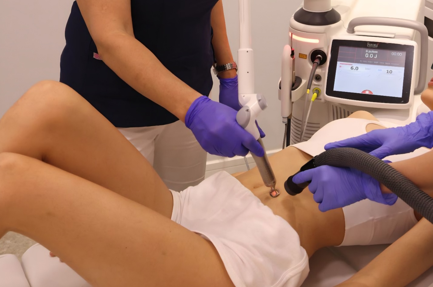 Lečenje strija laserom u Beogradu
