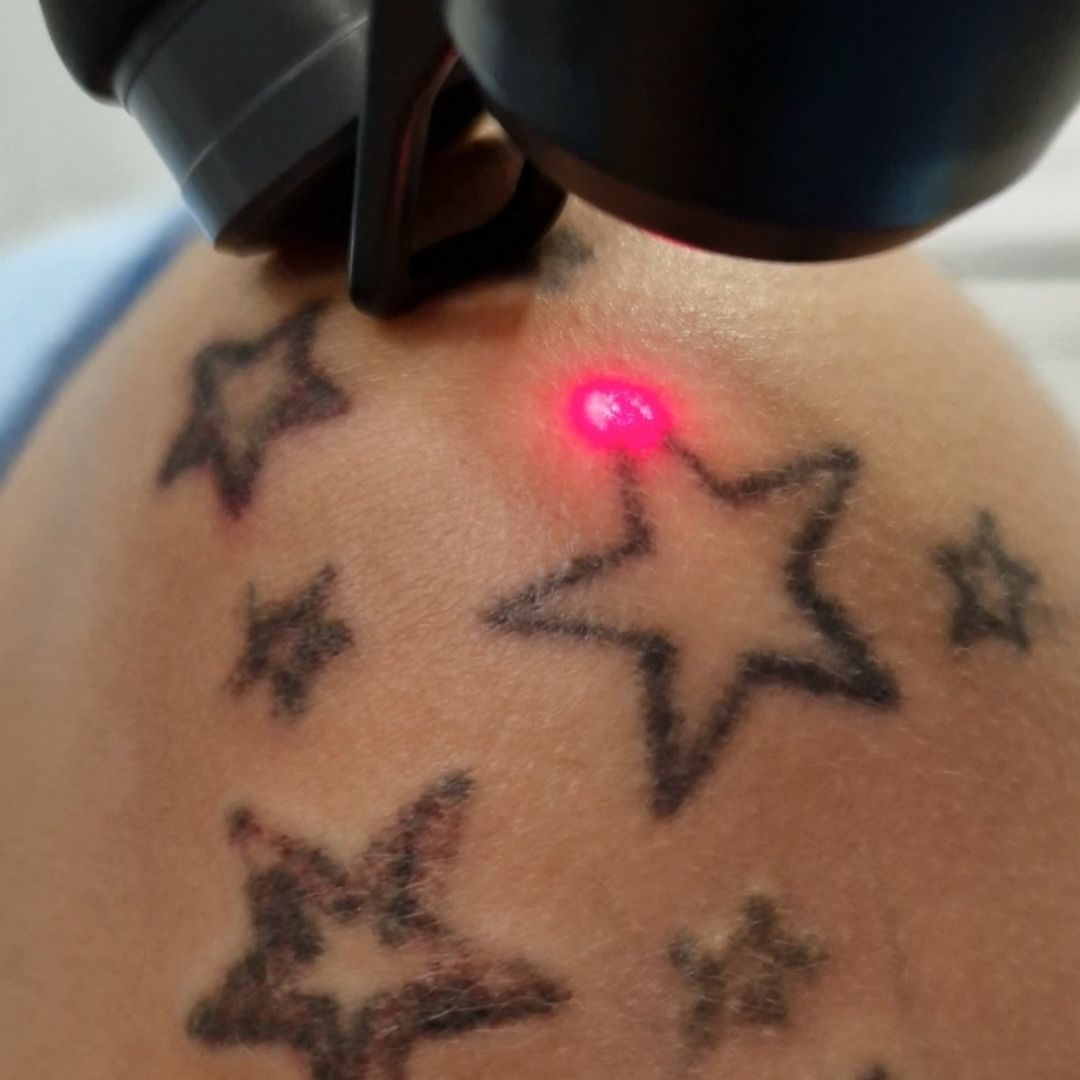 Lasersko uklanjanje tetovaža i trajne šminke obrva