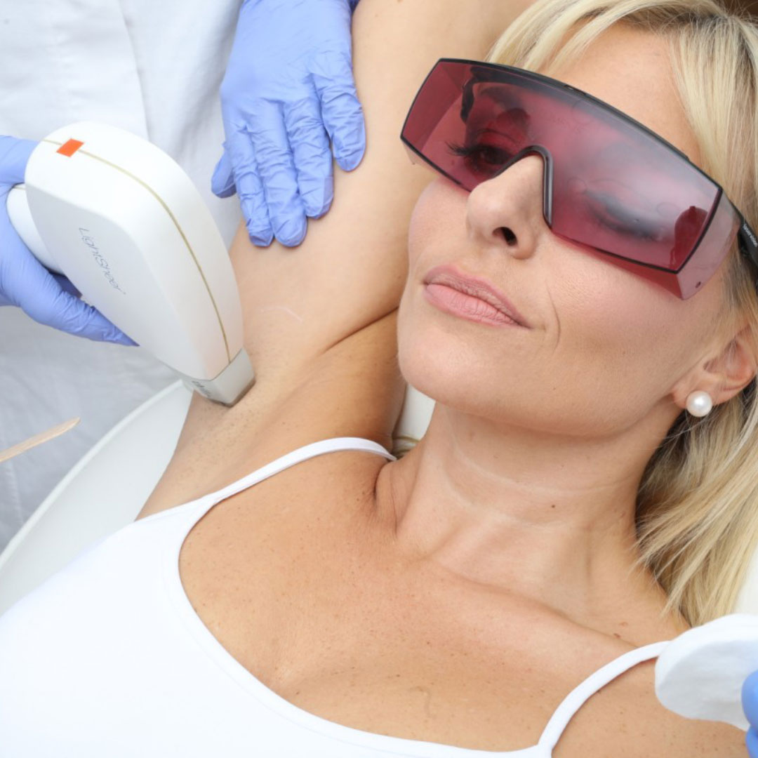 Epilacija medicinskim laserima