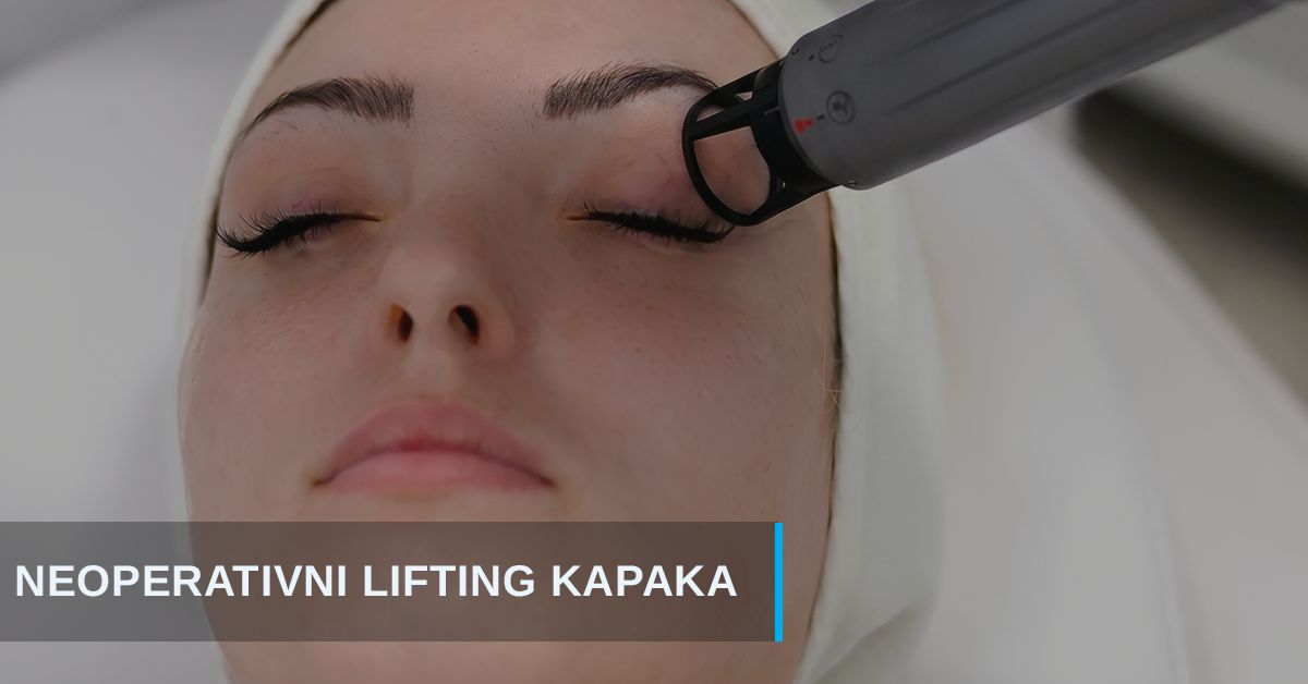 Neoperativni laserski lifting kapaka – podizanje kapaka bez operacije