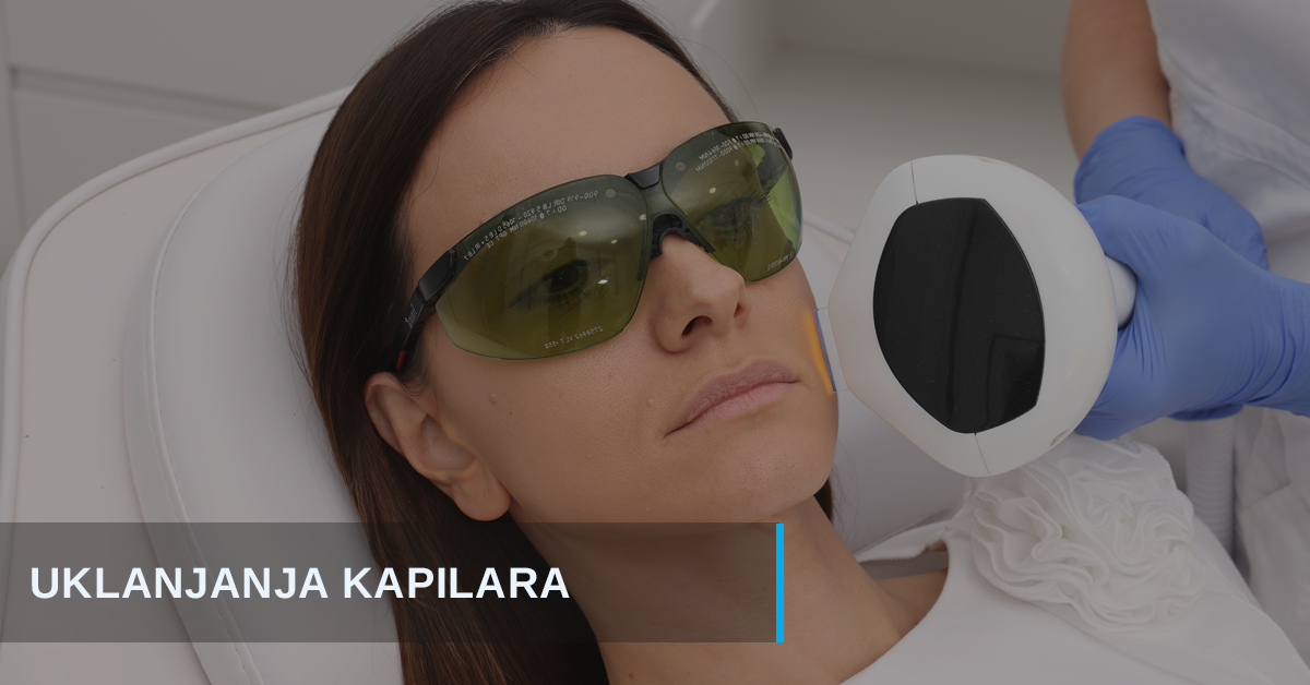 Uklanjanje kapilara laserom