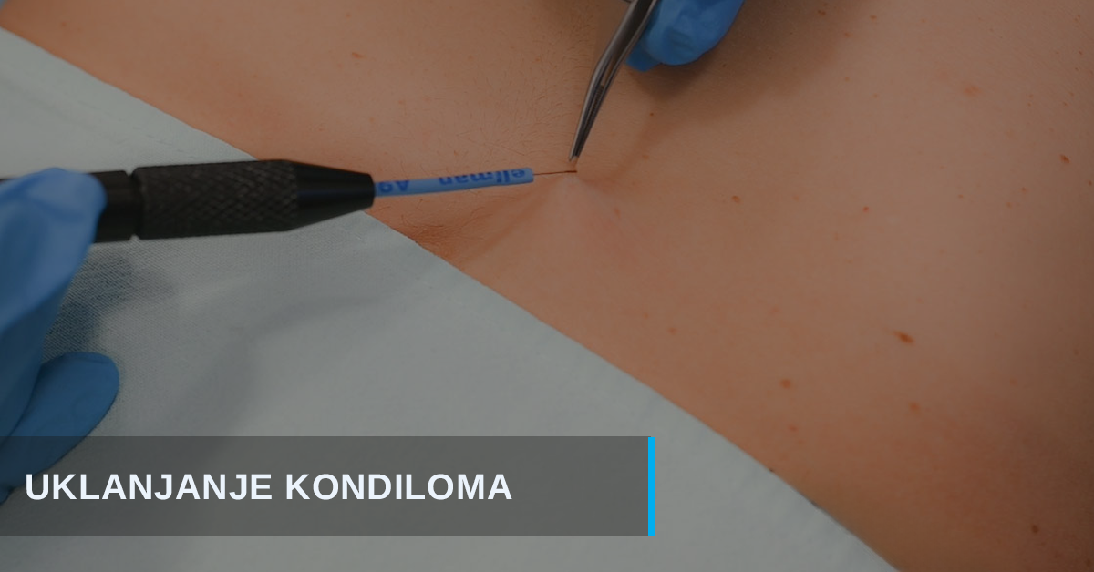 Kondilomi – kako ih je moguće EFIKASNO ukloniti?