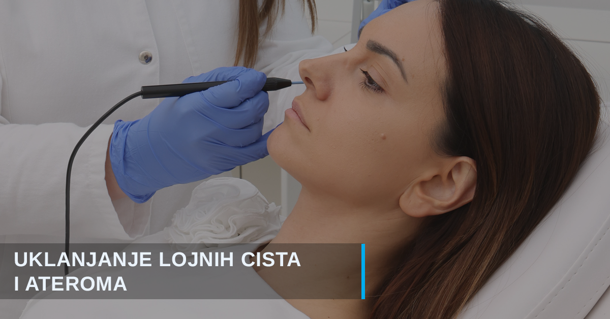 Uklanjanje lojnih cisti i ateroma u Beogradu – brzo, komforno i bez ponovne pojave
